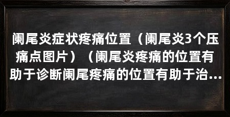 阑尾炎症状疼痛位置（阑尾炎3个压痛点图片）（阑尾炎疼痛的位置有助于诊断阑尾疼痛的位置有助于治疗