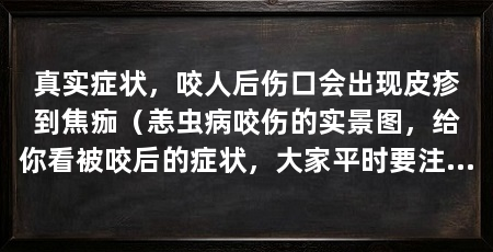 真实症状,咬人后伤口会出现皮疹到焦痂(恙虫病咬伤的实景图,给你看被咬后的症状,大家平时要注意防护